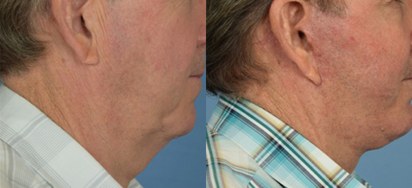 Male face, before and after Neck lift treatment, r-side view, patient 3