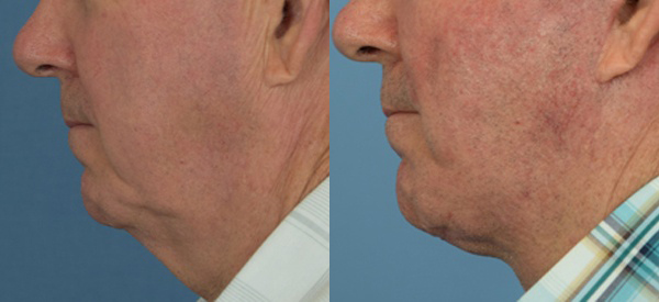 Male face, before and after Neck lift treatment, l-side view, patient 3