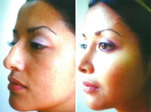  Female face, before and after Rhinoplasty treatment, l-side oblique view, patient 1