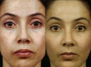  Female face, before and after Rhinoplasty treatment, front view, patient 10