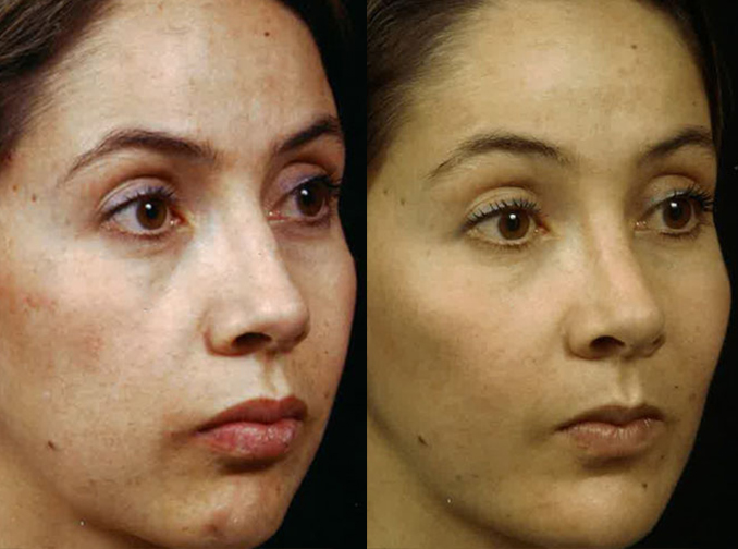 Female face, before and after Rhinoplasty treatment, r-side oblique view, patient 10