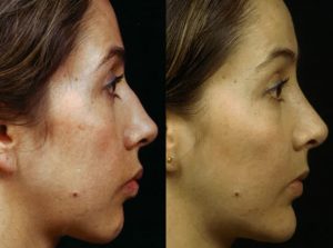  Female face, before and after Rhinoplasty treatment, r-side view, patient 10