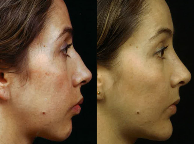 Female face, before and after Rhinoplasty treatment, r-side view, patient 10