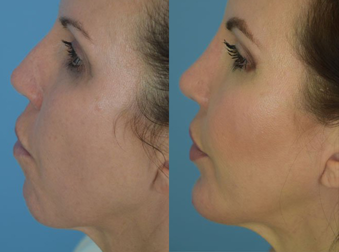 Female face, before and after Rhinoplasty treatment, l-side view, patient 11