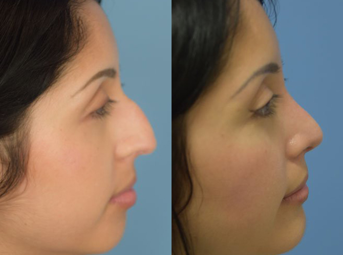 Female face, before and after Rhinoplasty treatment, r-side view, patient 12