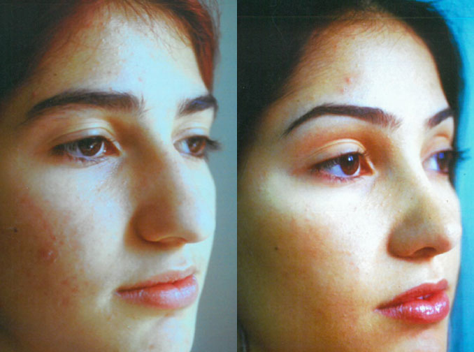 Female face, before and after Rhinoplasty treatment, r-side oblique view, patient 2