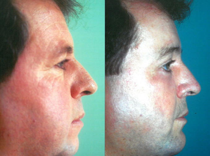 Male face, before and after Rhinoplasty treatment, r-side view, patient 3