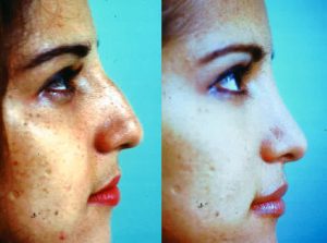 Rhinoplasty Before & After Patient5