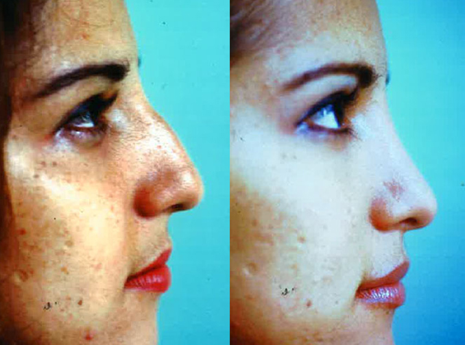 Female face, before and after Rhinoplasty treatment, r-side view, patient 4