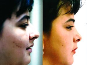  Female face, before and after Rhinoplasty treatment, r-side view, patient 5
