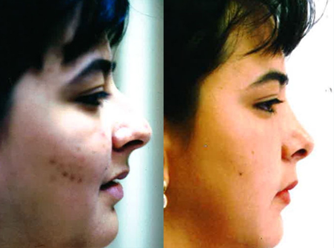 Female face, before and after Rhinoplasty treatment, r-side view, patient 5