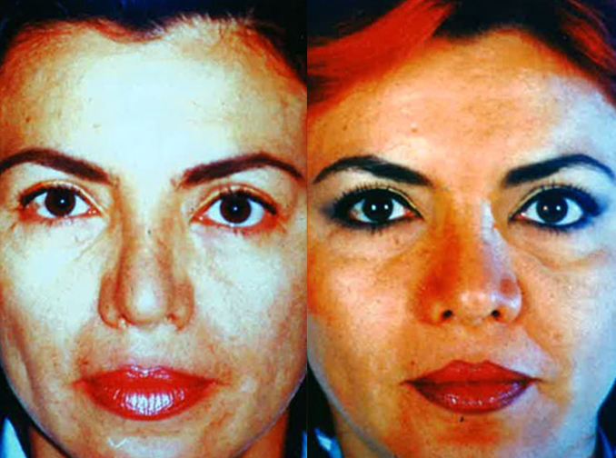 Female face, before and after Rhinoplasty treatment, front view, patient 6