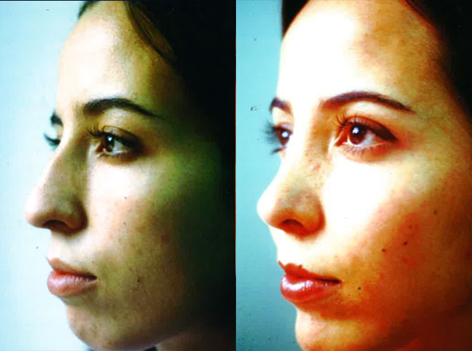 Female face, before and after Rhinoplasty treatment, l-side oblique view, patient 7
