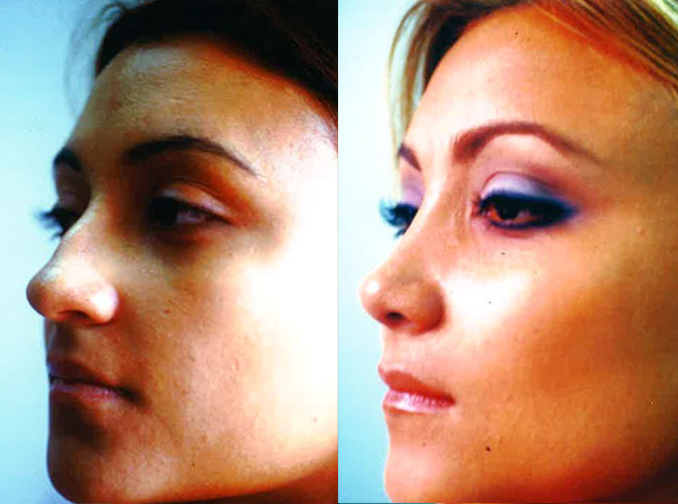 Female face, before and after Rhinoplasty treatment, l-side oblique view, patient 8