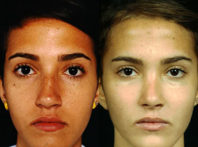 Female face, before and after Rhinoplasty treatment, front view, patient 9