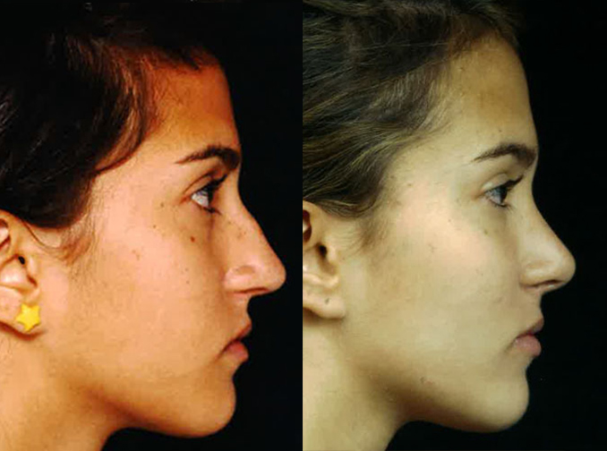 Female face, before and after Rhinoplasty treatment, r-side view, patient 9