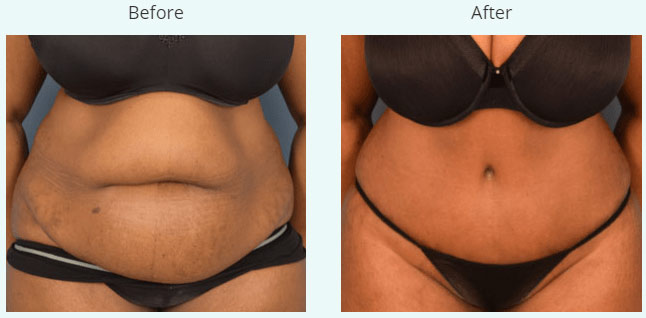 Female body, before and after Weight Loss treatment, front view, patient 2