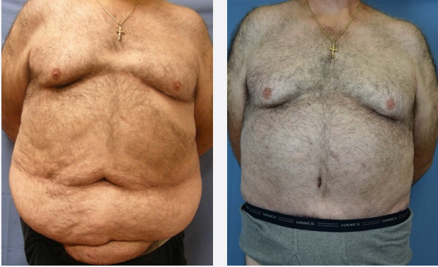 Photo of the patient’s body before & after the Male Body Lift surgery. Set 1: Patient 1