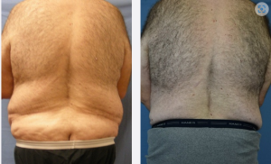 Male Body Lift Before & After Patient Miniature Set