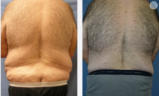 Photo of the patient’s body before & after the Male Body Lift surgery. Set 2: Patient 1