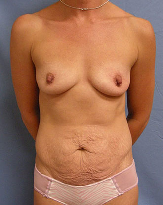 Female body, before Mommy Makeover treatment, front view