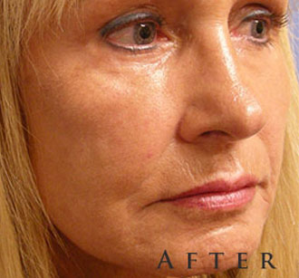 Female face, after Facial Fat Transfer treatment, oblique view