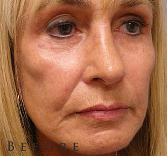 Female face, before Facial Fat Transfer treatment, oblique view