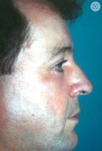 Male face, after Male Rhinoplasty treatment, side view