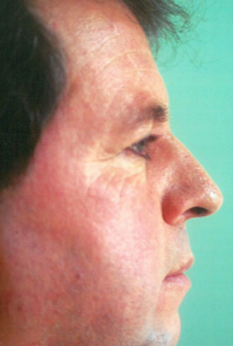 Male face, before Male Rhinoplasty treatment, side view