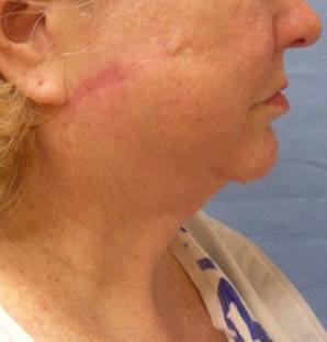 Female face, after Neck Lift treatment, side view