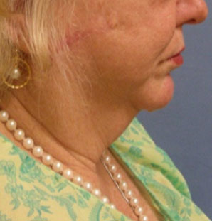 Female face, before Neck Lift treatment, side view
