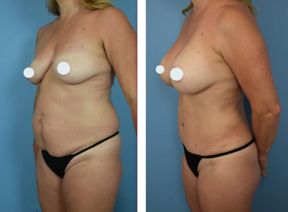 Woman's body, before and after mommy makeover treatment, oblique view