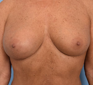  Female Breast, after Breast Augmentation treatment, front view, patient 3