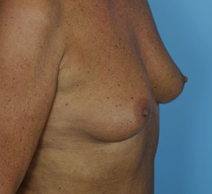  Female Breast, before Breast Augmentation treatment, r-side oblique view, patient 3