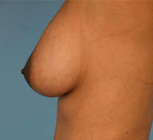  Female Breast, after Breast Augmentation treatment, l-side view, patient 4