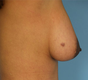  Female Breast, after Breast Augmentation treatment, r-side view, patient 4