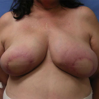 Woman's breast, after Breast Reconstruction treatment, front view