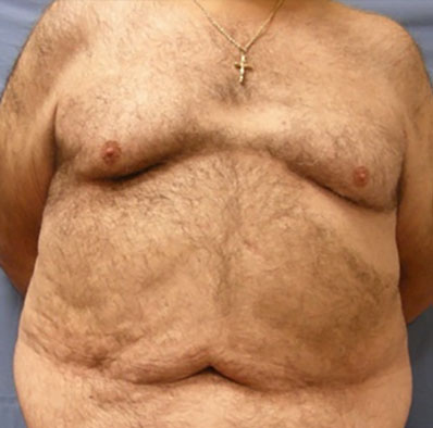 Male body, before Liposuction treatment, front view
