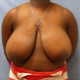 Woman's breast, before Breast Reduction Surgeon treatment, front view