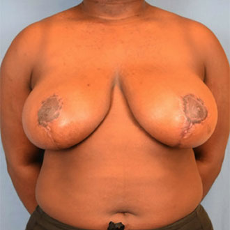 Woman's breast, after Breast Reduction Surgeon treatment, front view