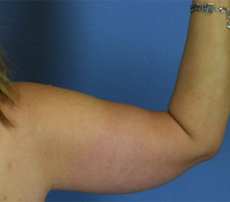 Female arm, after Arm Lift, front view, patient 1
