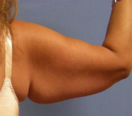Female arm, before Arm Lift, front view, patient 1