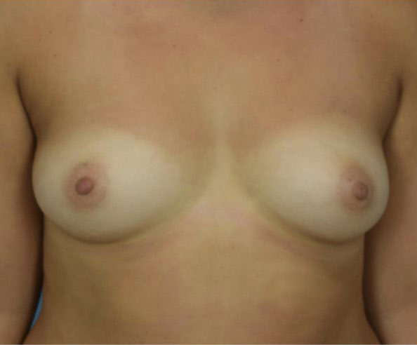 Woman’s breast, before Breast Fat Transfer treatment, front view