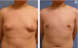 Male Breast Reduction Before & After Patient Miniature Set