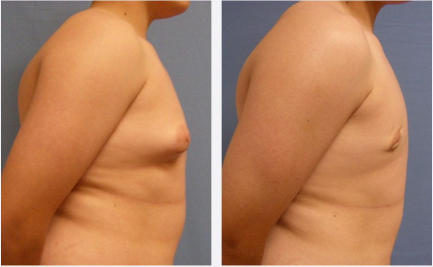 Photo of the patient’s body before & after the Male Breast Reduction surgery. Set 3: Patient 1