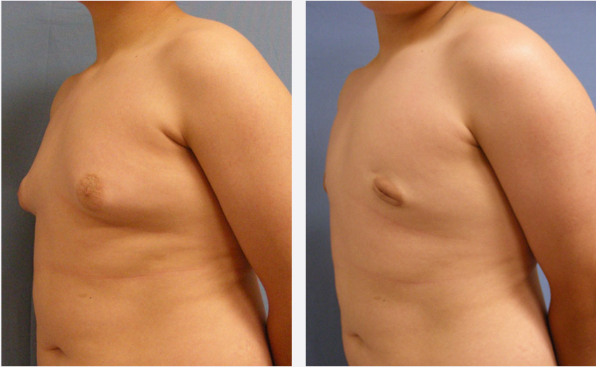 Photo of the patient’s body before & after the Male Breast Reduction surgery. Set 2: Patient 1