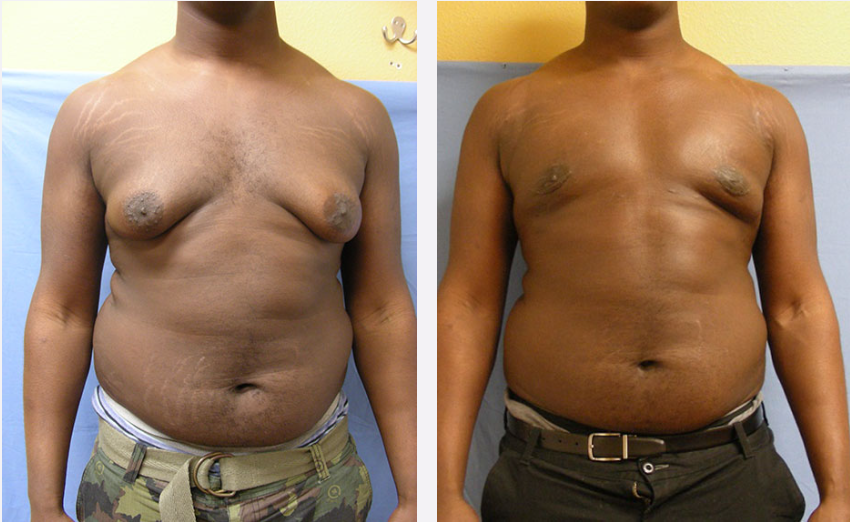 Photo of the patient’s body before & after the Male Breast Reduction surgery. Set 1: Patient 2