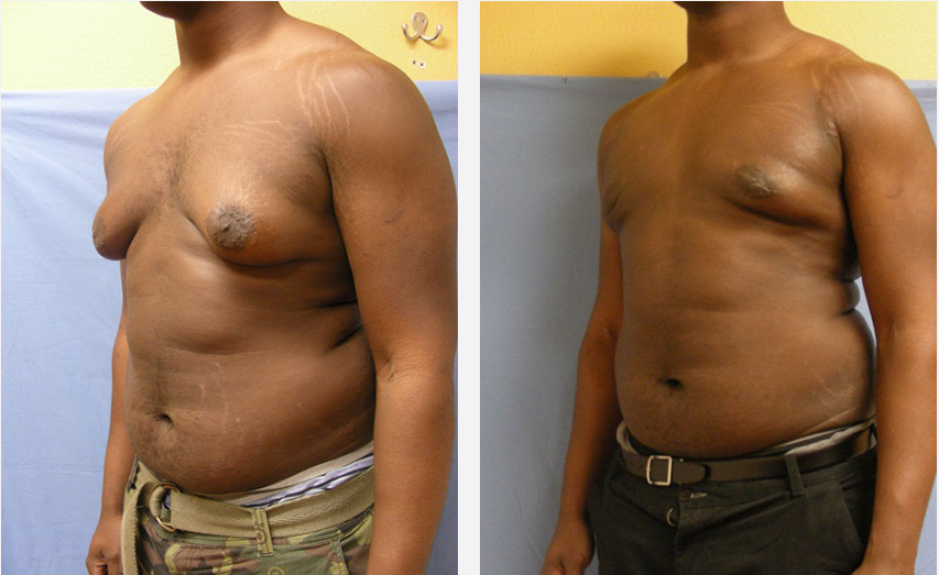Photo of the patient’s body before & after the Male Breast Reduction surgery. Set 2: Patient 2