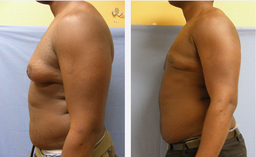 Photo of the patient’s body before & after the Male Breast Reduction surgery. Set 3: Patient 2
