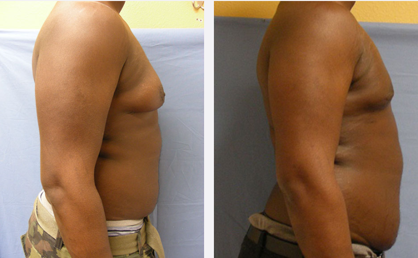 Photo of the patient’s body before & after the Male Breast Reduction surgery. Set 4: Patient 2